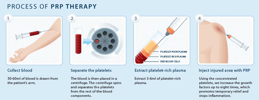 Process of PRP Therapy in Miami